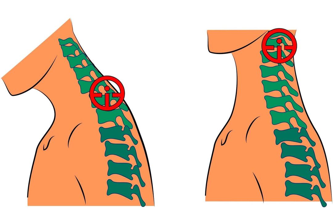 cervical osteochondrosis