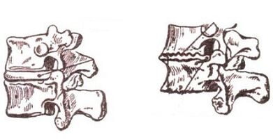 Stages of development of cervical osteochondrosis