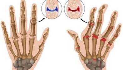 The main differences of arthritis and arthritis