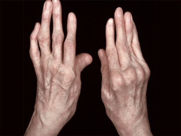 arthritis as a cause of pain in the finger joints