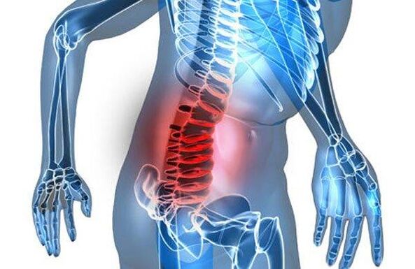 Deformation of the spine in the fourth stage of lumbar osteochondrosis
