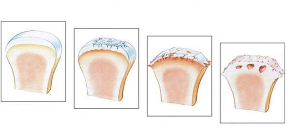Healthy articulation and 3 degrees of arthrosis development