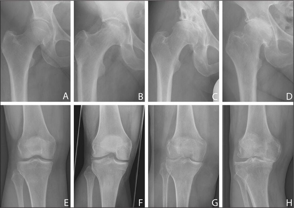 Stages of development of joint arthrosis on an X-ray